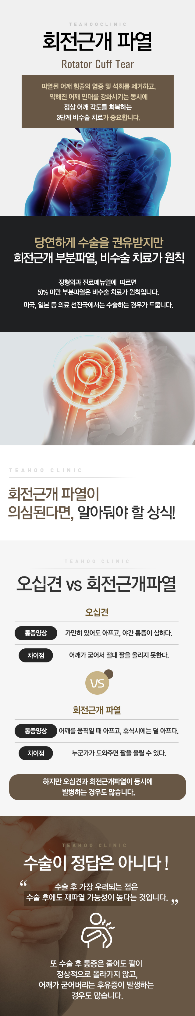 회전근개파열