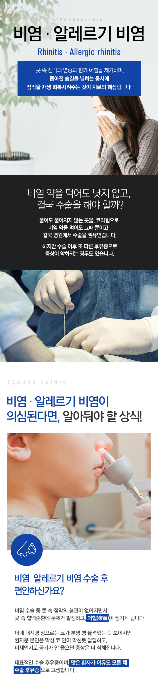 비염