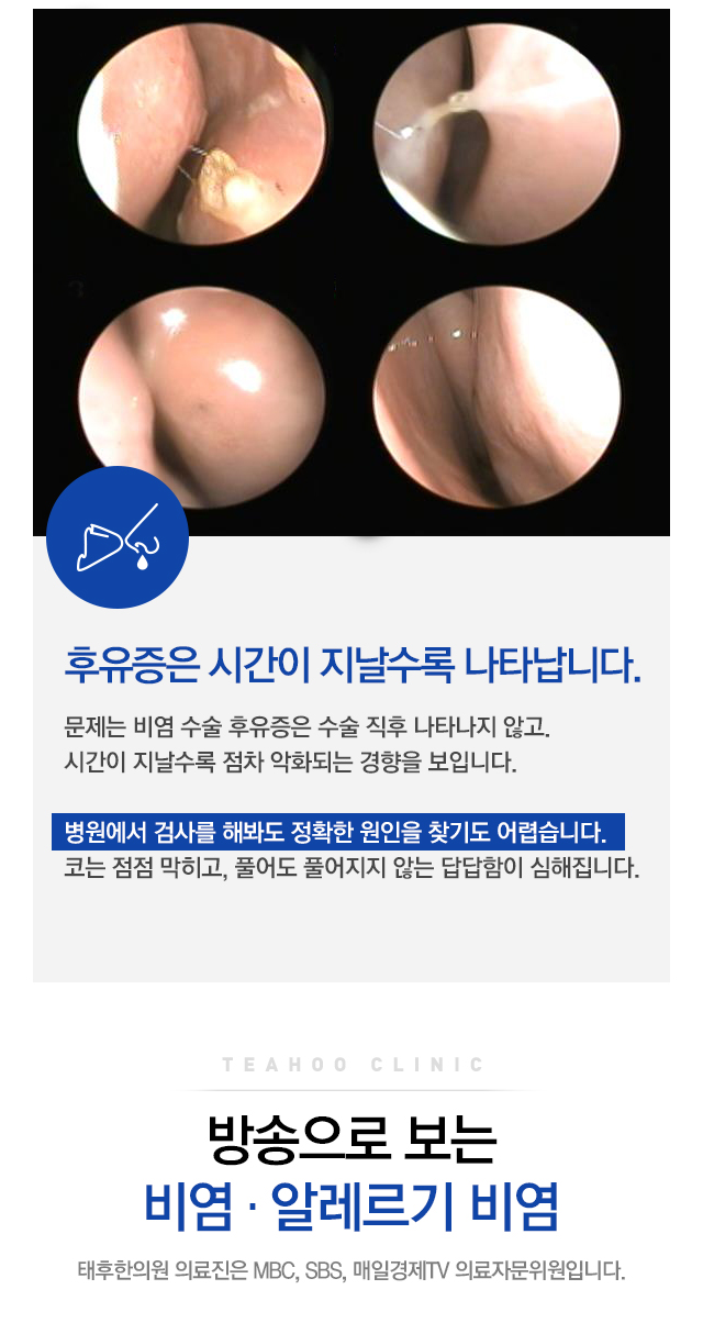 비염