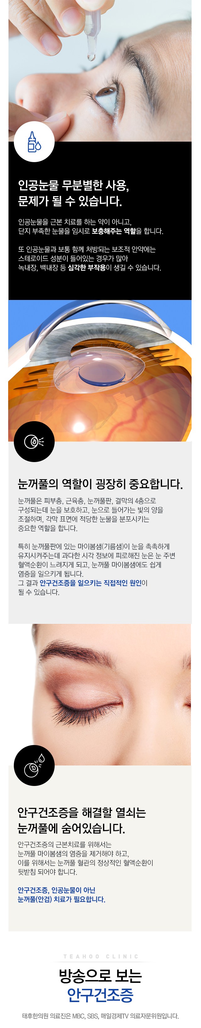 안구건조증