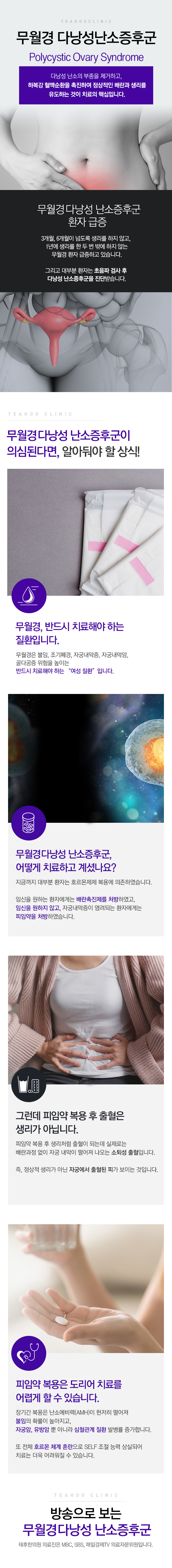 무월경/다낭성난소증후군